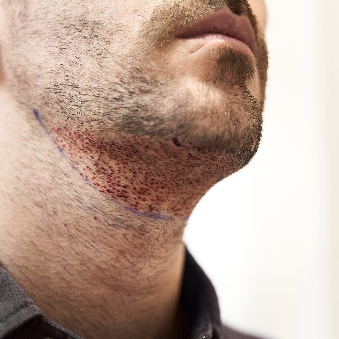 Man after beard transplant recovery