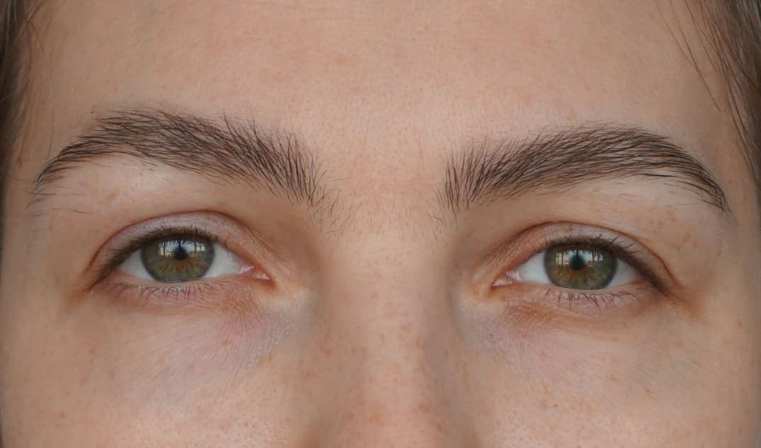 Ideal eyebrow transplant candidate with perfect brows