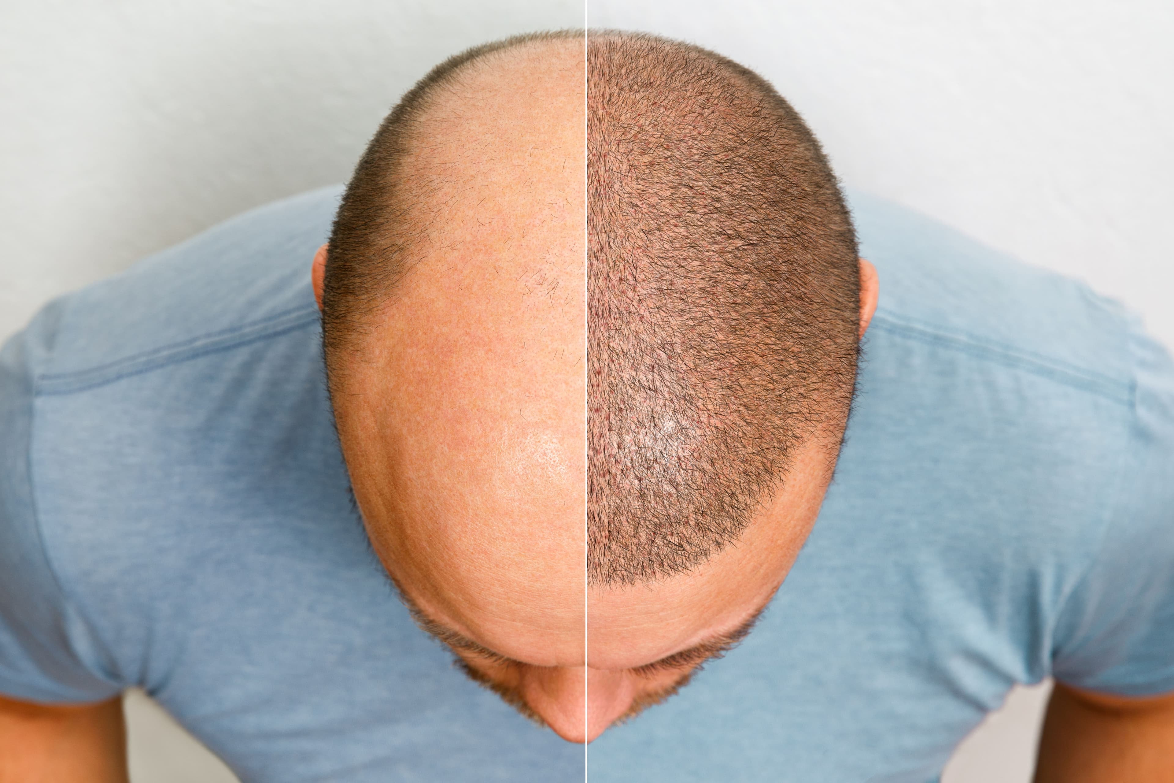 Hair transplant before and after results showing improvement in hair coverage