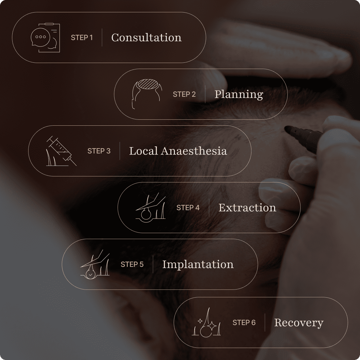 Hair transplant procedure steps: consultation, planning, local anaesthesia, extraction, implantation, and recovery