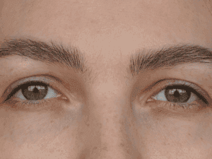 Eyebrow Transplant