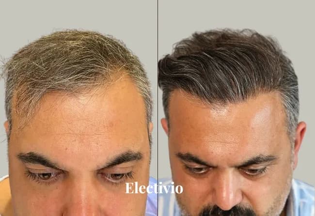 Before and after hair transplant results
