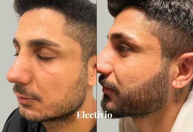 Beard transplant before and after results - Patient 11