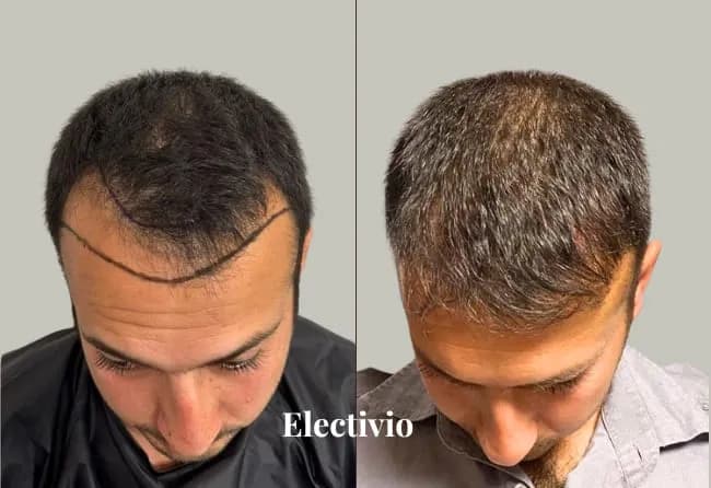 Hair transplant before and after results - Patient 15