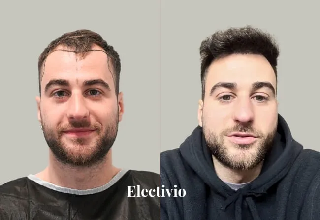 Before and after hair transplant results