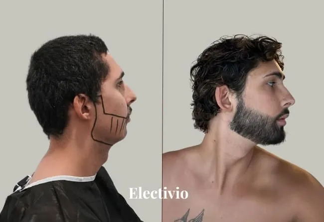 Hair transplant before and after results - Patient 18