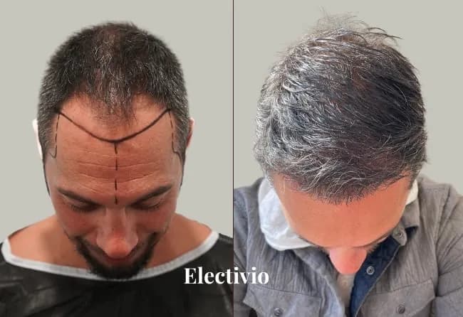Hair transplant before and after results - Patient 20