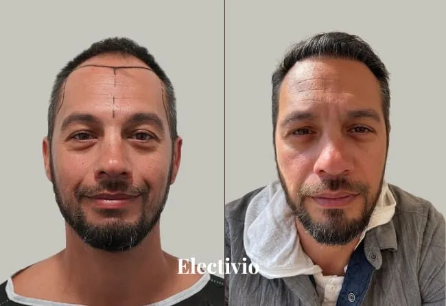Hair transplant before and after results - Patient 21
