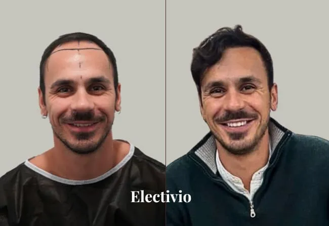 Hair transplant before and after results - Patient 22