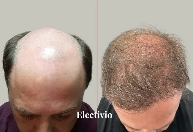 Beard transplant before and after results - Patient 25