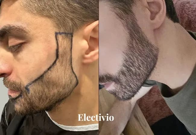 Before and after hair transplant results