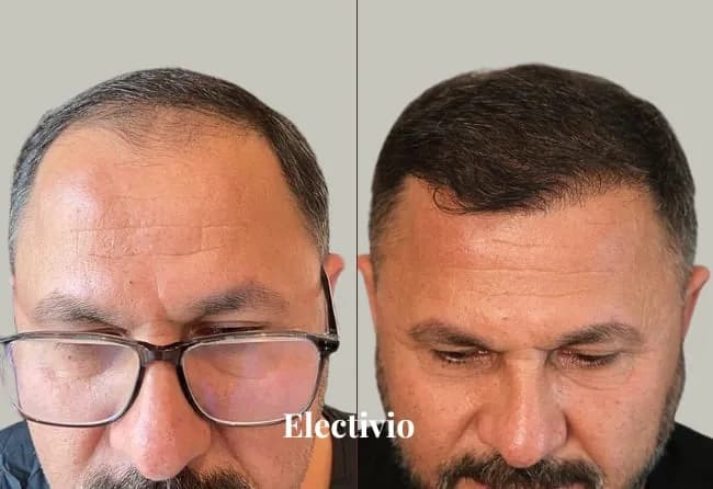 Before and after hair transplant results