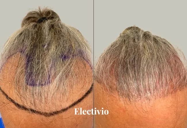 Before and after hair transplant results