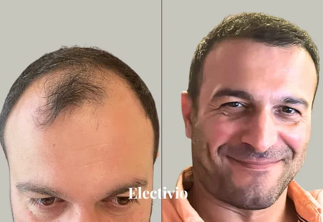 Before and after hair transplant results