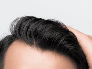 Hair Transplants