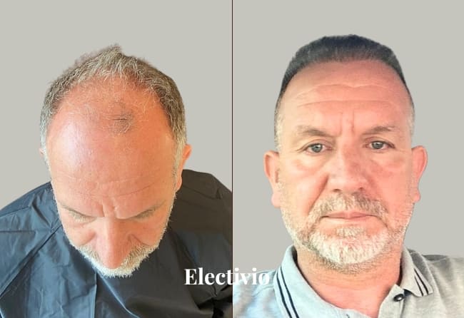 Hair transplant before and after results - Patient 12