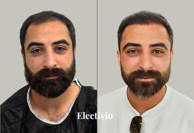Beard transplant before and after results - Patient 13