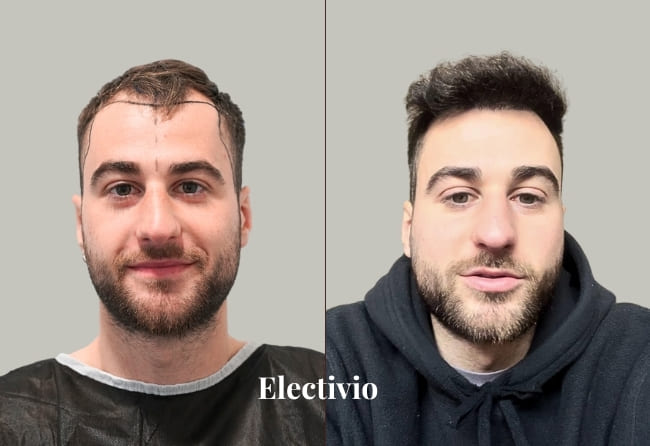 Hair transplant before and after results - Patient 23