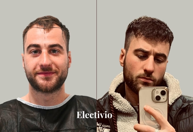 Hair transplant before and after results - Patient 17