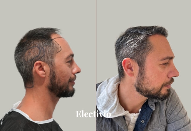 Hair transplant before and after results - Patient 19