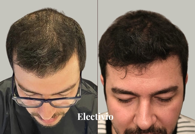 Hair transplant before and after results - Patient 2