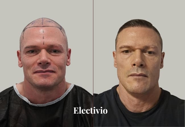 Hair transplant before and after results - Patient 24