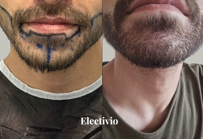 Beard transplant before and after results - Patient 26