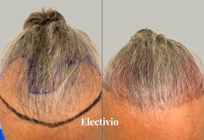 Hair transplant before and after results - Patient 5