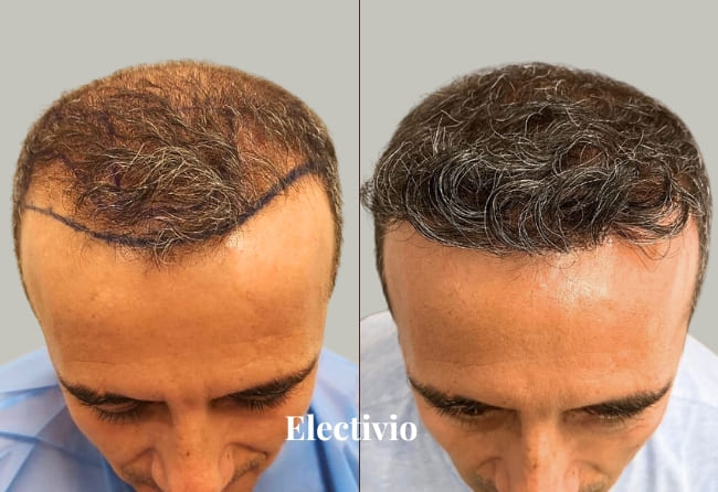 Hair transplant before and after results - Patient 6