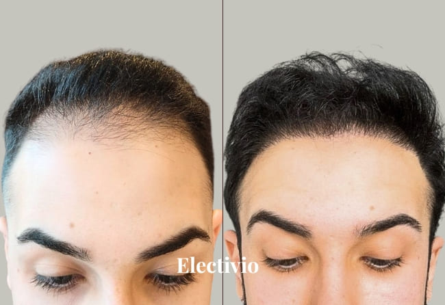 Hair transplant before and after results - Patient 7